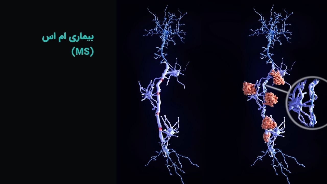 شناسایی ۱۱۲ هزار بیمار مبتلا به MS در ایران
