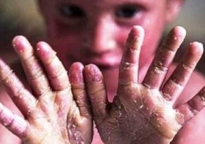 تقویت حمایت‌های هدفمند و خدمات تخصصی از بیماری‌های نادر