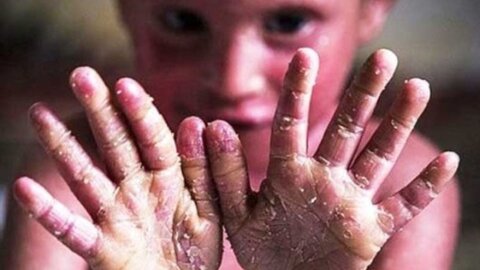 تقویت حمایت‌های هدفمند و خدمات تخصصی از بیماری‌های نادر