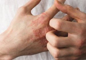 توصیه‌هایی درباره یک عارضه پوستیِ شایع؛ افزایش خشکی پوست با افزایش سن