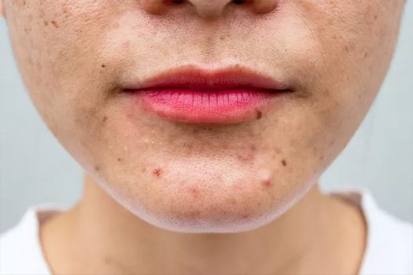 کمبود کدام ویتامین‌ها روی صورت شما اثر می‌گذارد؟