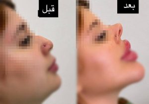 «بینی به سبک خوکی»؛ وقتی طبیعی بودن دیگه کافی نیست!