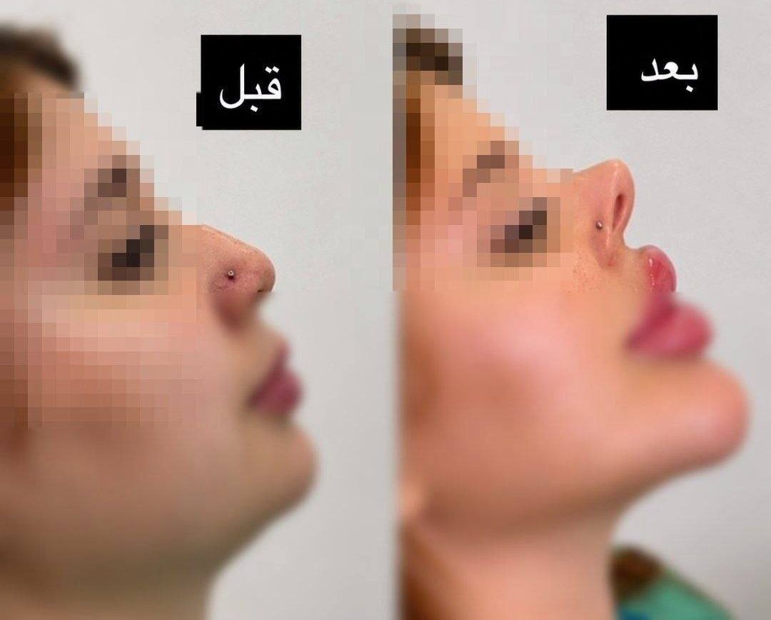 «بینی به سبک خوکی»؛ وقتی طبیعی بودن دیگه کافی نیست!